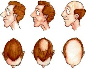 Gubitak kose - Alopecia androgenetica